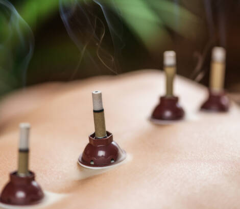 Mugwort moxibustion Back Therapy. Burning Moxa stick placed near acupuncture point on the patient's back.